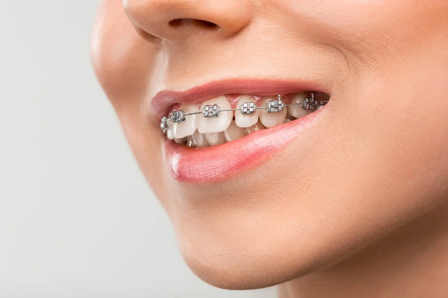 A smiling person with metal dental braces, as seen at Emerald City Orthodontics in Kirkland WA, for overbite correction.