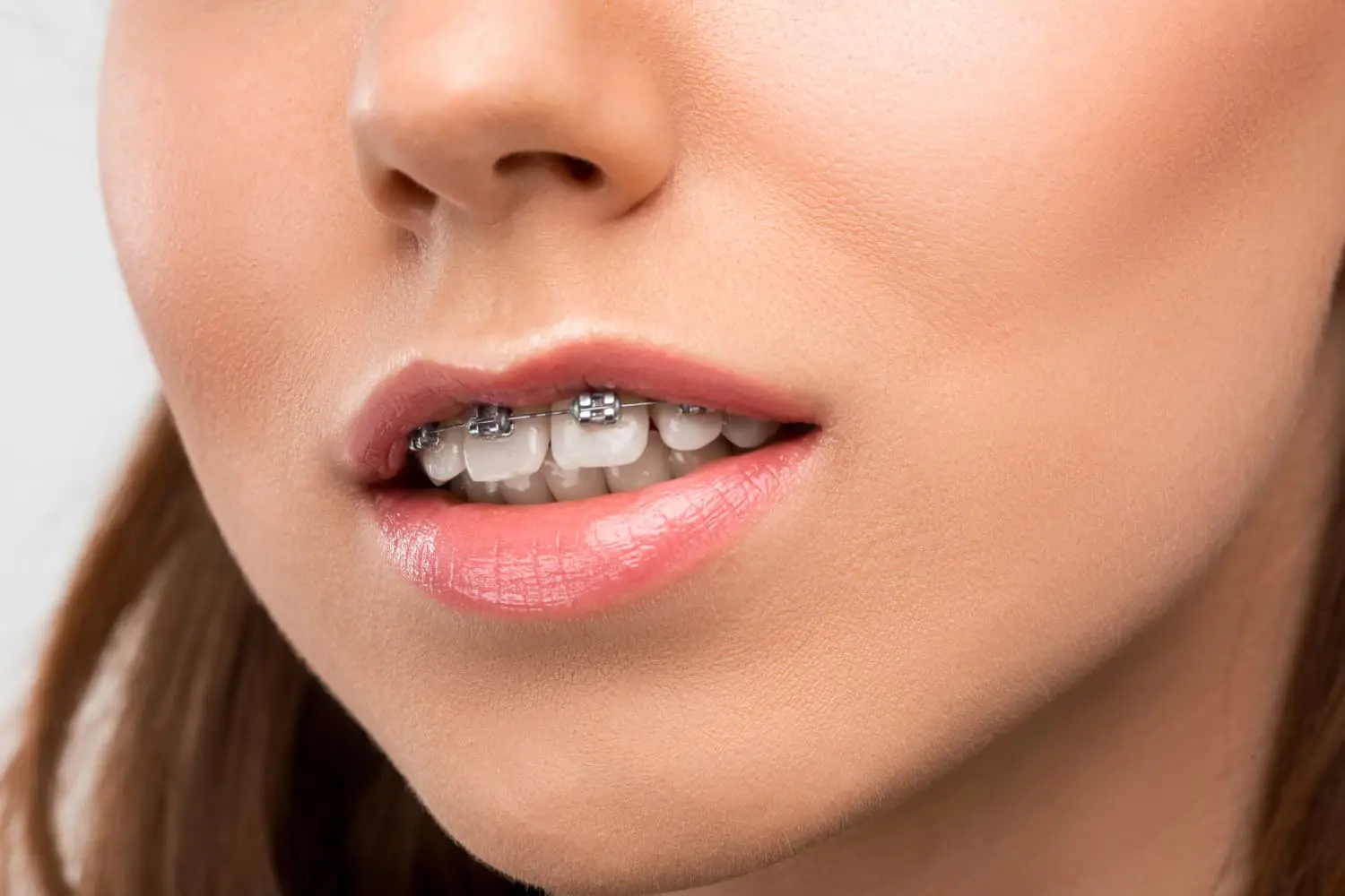 A person's lower face with metal braces correcting an overbite, at Emerald City Orthodontics in Kirkland, WA.