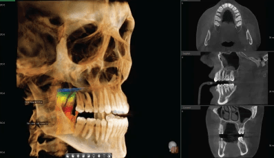 3D skull scan with highlighted jaw and dental X-ray sections showing advanced bone structure at Emerald City Orthodontics in Kirkland, WA.