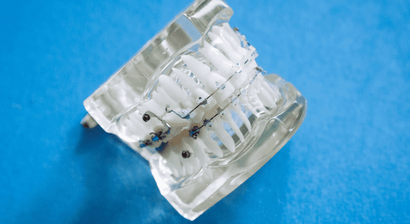 A clear dental model with metal braces is shown on a blue surface at Emerald City Orthodontics in Kirkland, WA.