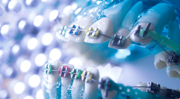 Dental models with metal braces and colored bands, at Emerald City Orthodontics in Kirkland WA, shown against a blurred background.