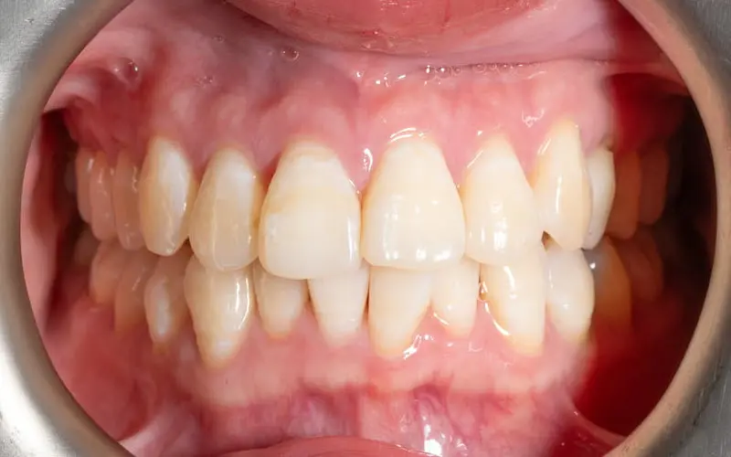Before Invisalign at Emerald City Orthodontics in Kirkland, WA: close-up of teeth with mild gum redness and plaque near the gums.