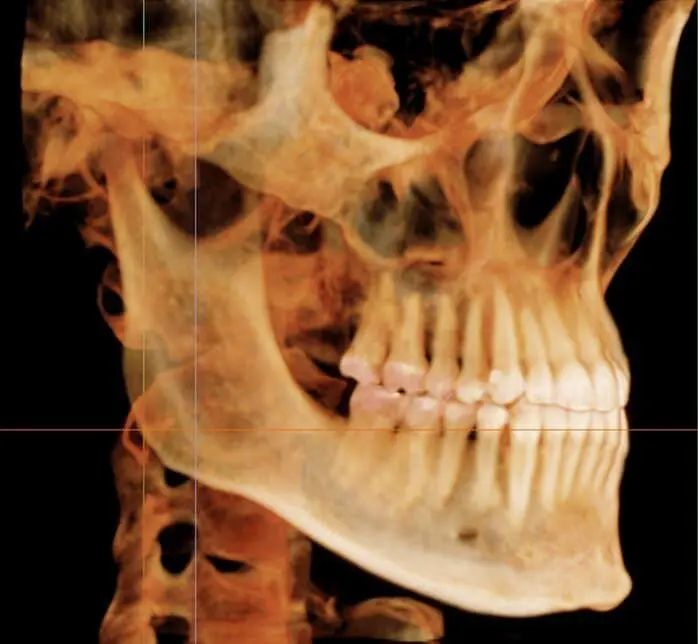 Side-view 3D dental X-ray of a skull with teeth and jawbone, from Emerald City Orthodontics in Kirkland, WA.