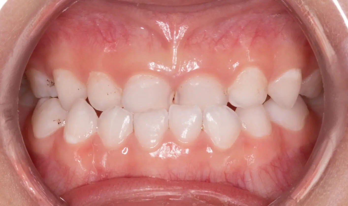 Before image showing a patient with a crossbite at Emerald City Orthodontics, Kirkland, WA.