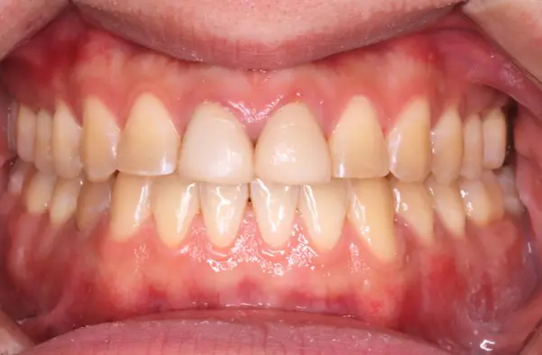 After successful treatment of a severe crossbite at Emerald City Orthodontics, Kirkland. The teeth now align perfectly, showing a correct, healthy bite.