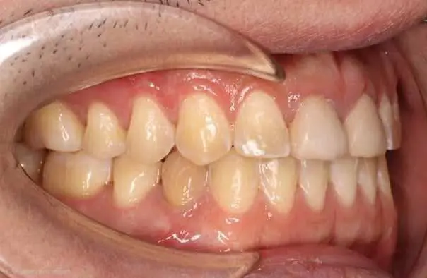 Patient's teeth and gums at Emerald City Orthodontics in Kirkland, WA, mouth open with retractor, showing natural alignment pre-treatment.