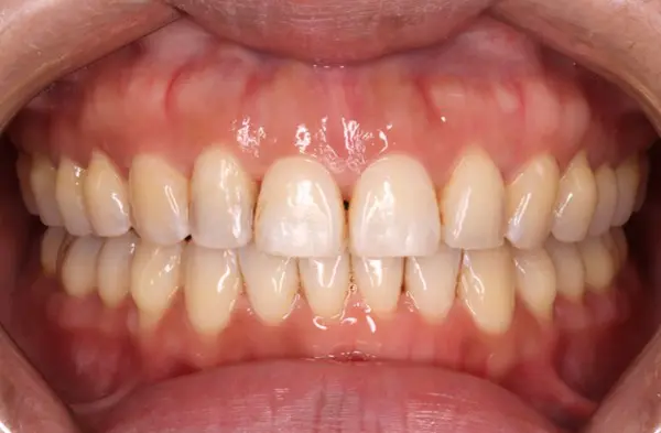 After orthodontic treatment for a crossbite at Emerald City Orthodontics, Kirkland. The result shows perfectly aligned teeth and a proper bite correction.