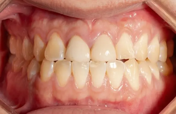 Before image showing a patient with a crossbite at Emerald City Orthodontics, Kirkland, WA.
