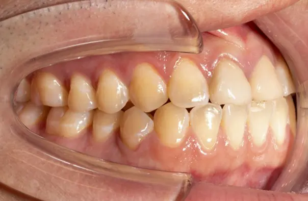 Before image showing a patient with a crossbite at Emerald City Orthodontics, Kirkland, WA.