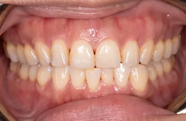 Before image showing a patient with a crossbite at Emerald City Orthodontics, Kirkland, WA.