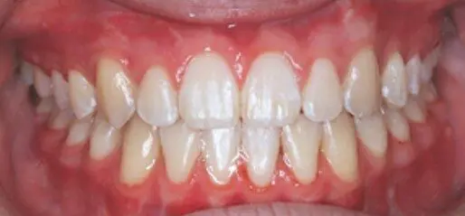 Full set of healthy teeth and gums after braces at Emerald City Orthodontics in Kirkland, WA, shown in close-up.