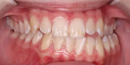 At Emerald City Orthodontics in Kirkland, WA, close-up of a mouth shows overbite and mild lower teeth crowding before braces.