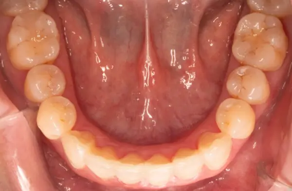 After successful crowding correction treatment at Emerald City Orthodontics in Kirkland, WA