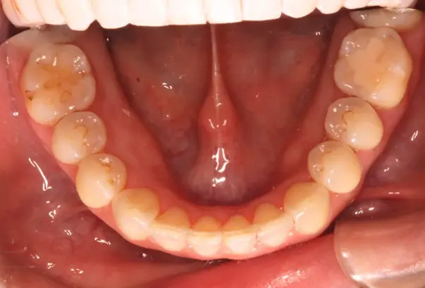 After successful crowding correction treatment at Emerald City Orthodontics in Kirkland, WA