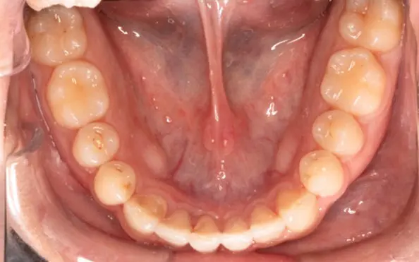 After successful crowding correction treatment at Emerald City Orthodontics in Kirkland, WA