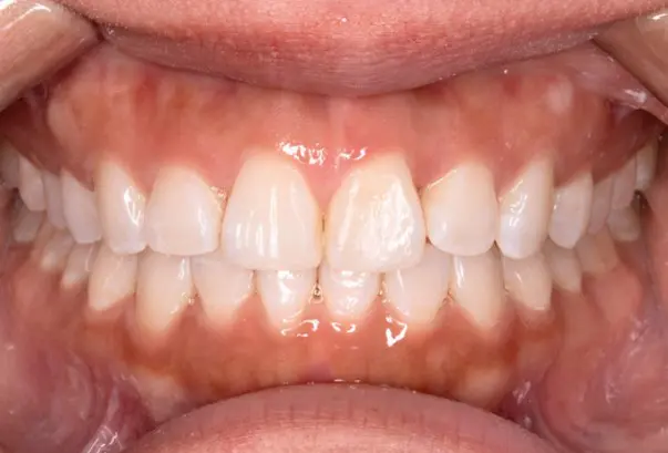 After successful crowding correction treatment at Emerald City Orthodontics in Kirkland, WA
