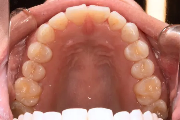 After successful crowding correction treatment at Emerald City Orthodontics in Kirkland, WA