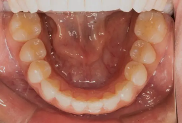 After successful crowding correction treatment at Emerald City Orthodontics in Kirkland, WA