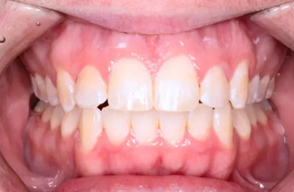 After successful crowding correction treatment at Emerald City Orthodontics in Kirkland, WA