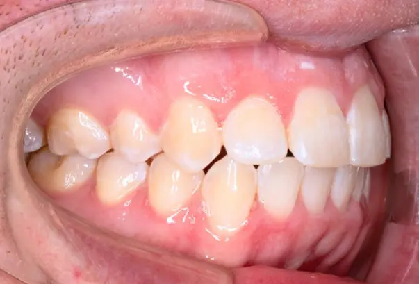 After successful crowding correction treatment at Emerald City Orthodontics in Kirkland, WA