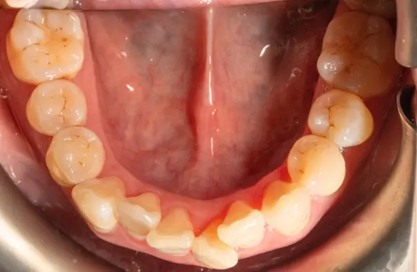 Before orthodontic treatment for severe dental crowding at Emerald City Orthodontics in Kirkland, WA.