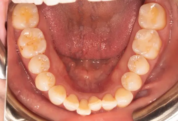 Before orthodontic treatment for severe dental crowding at Emerald City Orthodontics in Kirkland, WA.