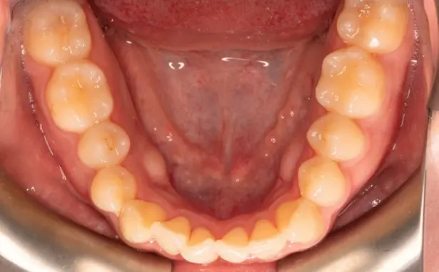 Before orthodontic treatment for severe dental crowding at Emerald City Orthodontics in Kirkland, WA.