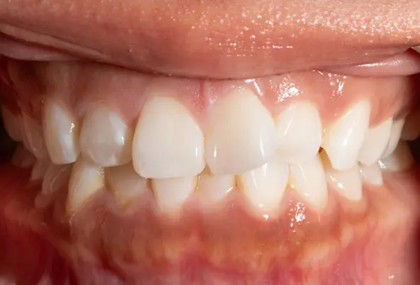 Before orthodontic treatment for severe dental crowding at Emerald City Orthodontics in Kirkland, WA.