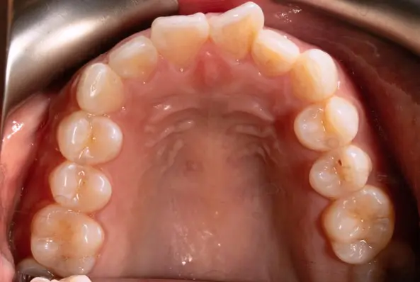 Before orthodontic treatment for severe dental crowding at Emerald City Orthodontics in Kirkland, WA.