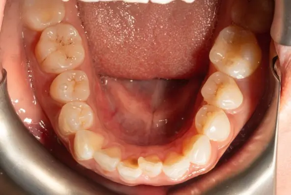 Before orthodontic treatment for severe dental crowding at Emerald City Orthodontics in Kirkland, WA.