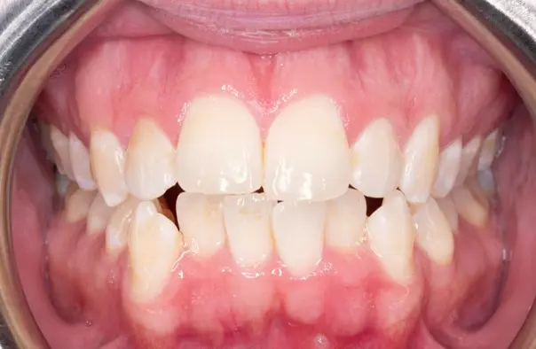 Before orthodontic treatment for severe dental crowding at Emerald City Orthodontics in Kirkland, WA.