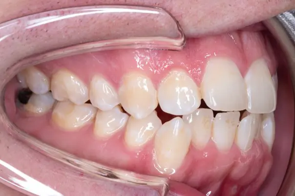 Before orthodontic treatment for severe dental crowding at Emerald City Orthodontics in Kirkland, WA.