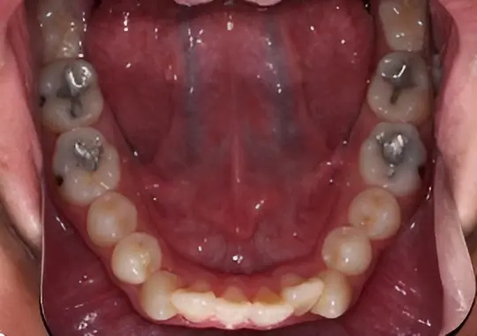 Before orthodontic treatment for severe dental crowding at Emerald City Orthodontics in Kirkland, WA.