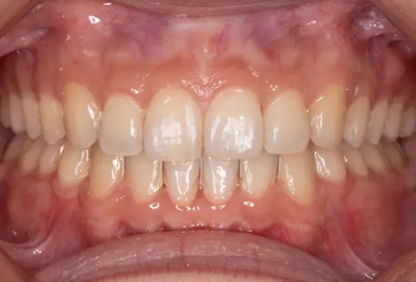 After successful deep bite treatment at Emerald City Orthodontics in Kirkland, WA.