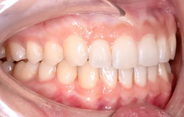 After successful deep bite treatment at Emerald City Orthodontics in Kirkland, WA.