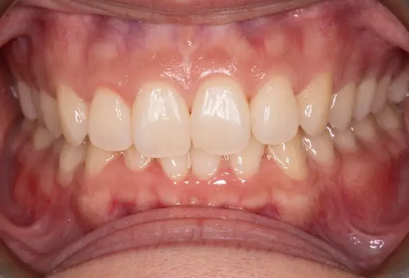 Before deep bite correction at Emerald City Orthodontics in Kirkland, WA.