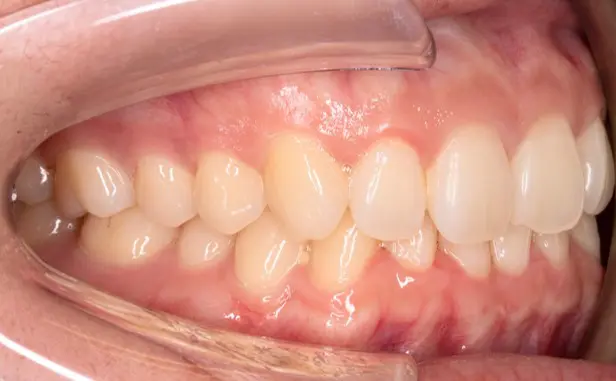 Before deep bite correction at Emerald City Orthodontics in Kirkland, WA.