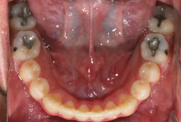 After successful crowding correction treatment at Emerald City Orthodontics in Kirkland, WA