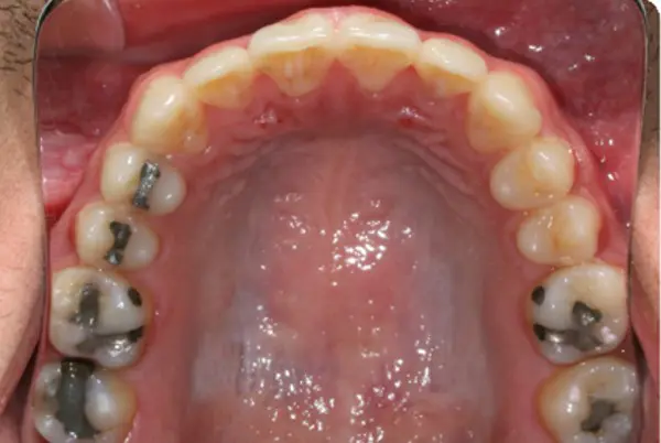 After successful arch expansion at Emerald City Orthodontics, Kirkland, WA.