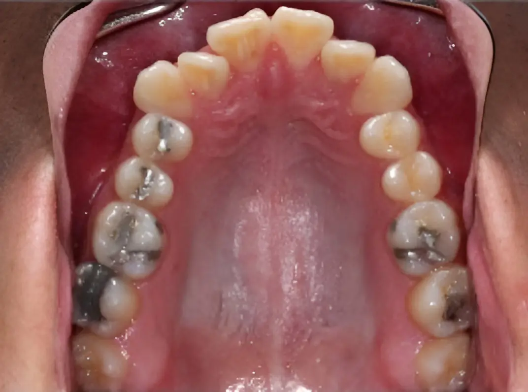 Before palatal expansion treatment for a narrow upper arch at Emerald City Orthodontics in Kirkland, WA.