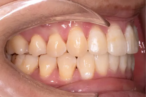 After successful correction of severe flared front teeth at Emerald City Orthodontics in Kirkland, WA.