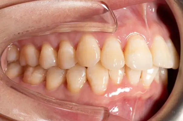 Before orthodontic treatment for flared front teeth (protrusion) at Emerald City Orthodontics in Kirkland, WA.