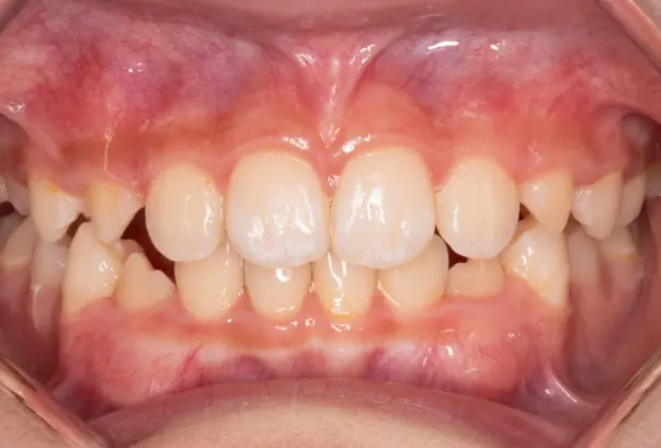 After orthodontic treatment correcting flared teeth and protrusion at Emerald City Orthodontics in Kirkland, WA.