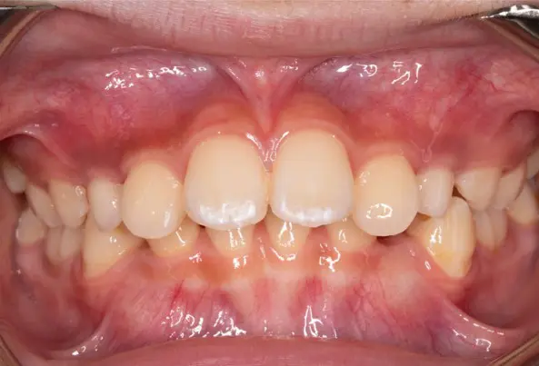 Before photo of severe flared teeth (protrusion) case at Emerald City Orthodontics in Kirkland, WA.