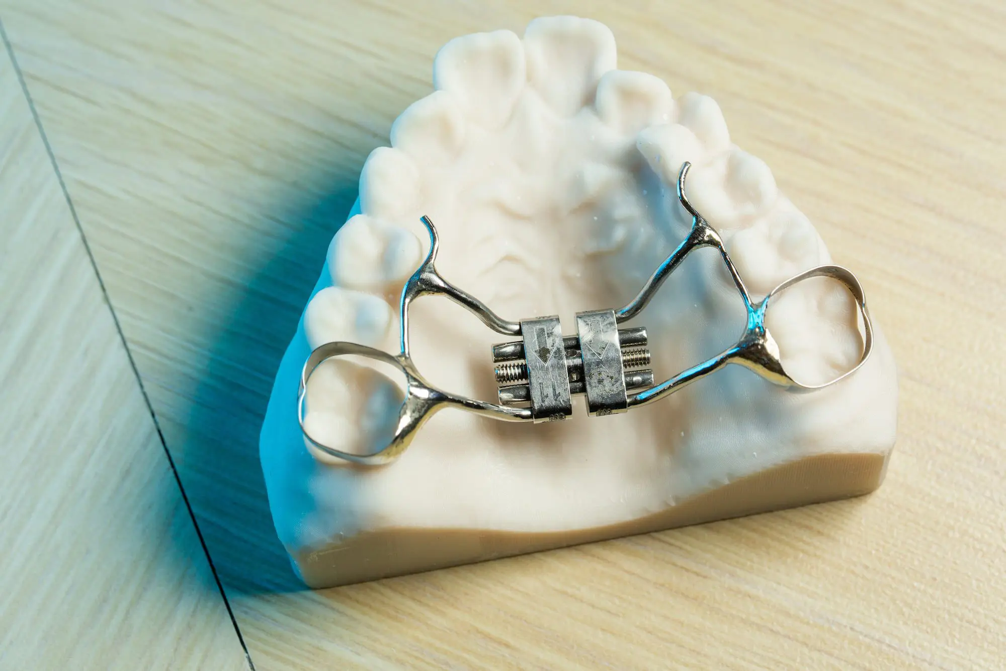 On a wooden surface, a dental mold with a Palatal Expander is shown at Emerald City Orthodontics in Kirkland, WA.