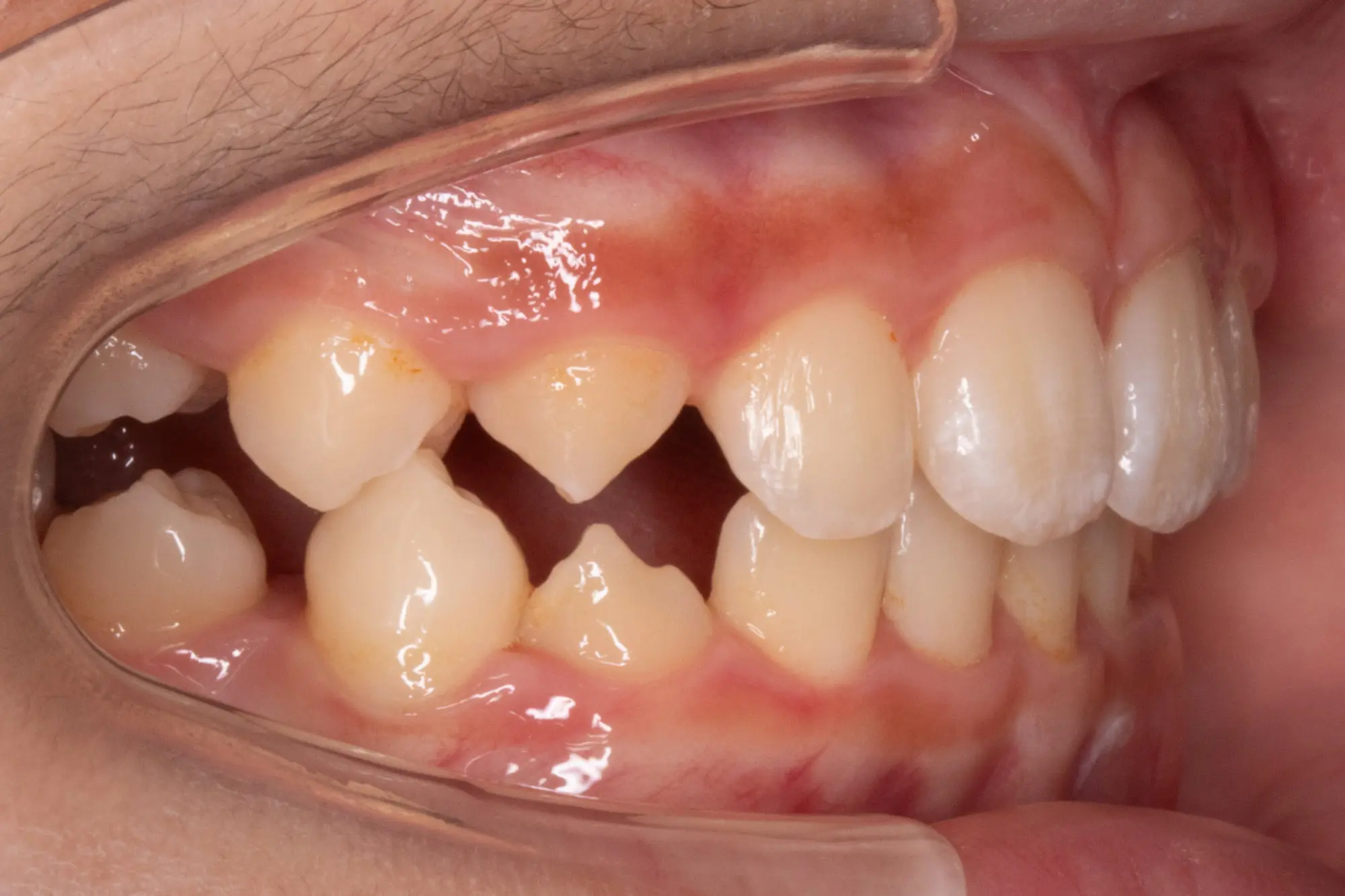 Misaligned teeth with crowding and gaps visible, dental retractor in use at Emerald City Orthodontics in Kirkland, WA.