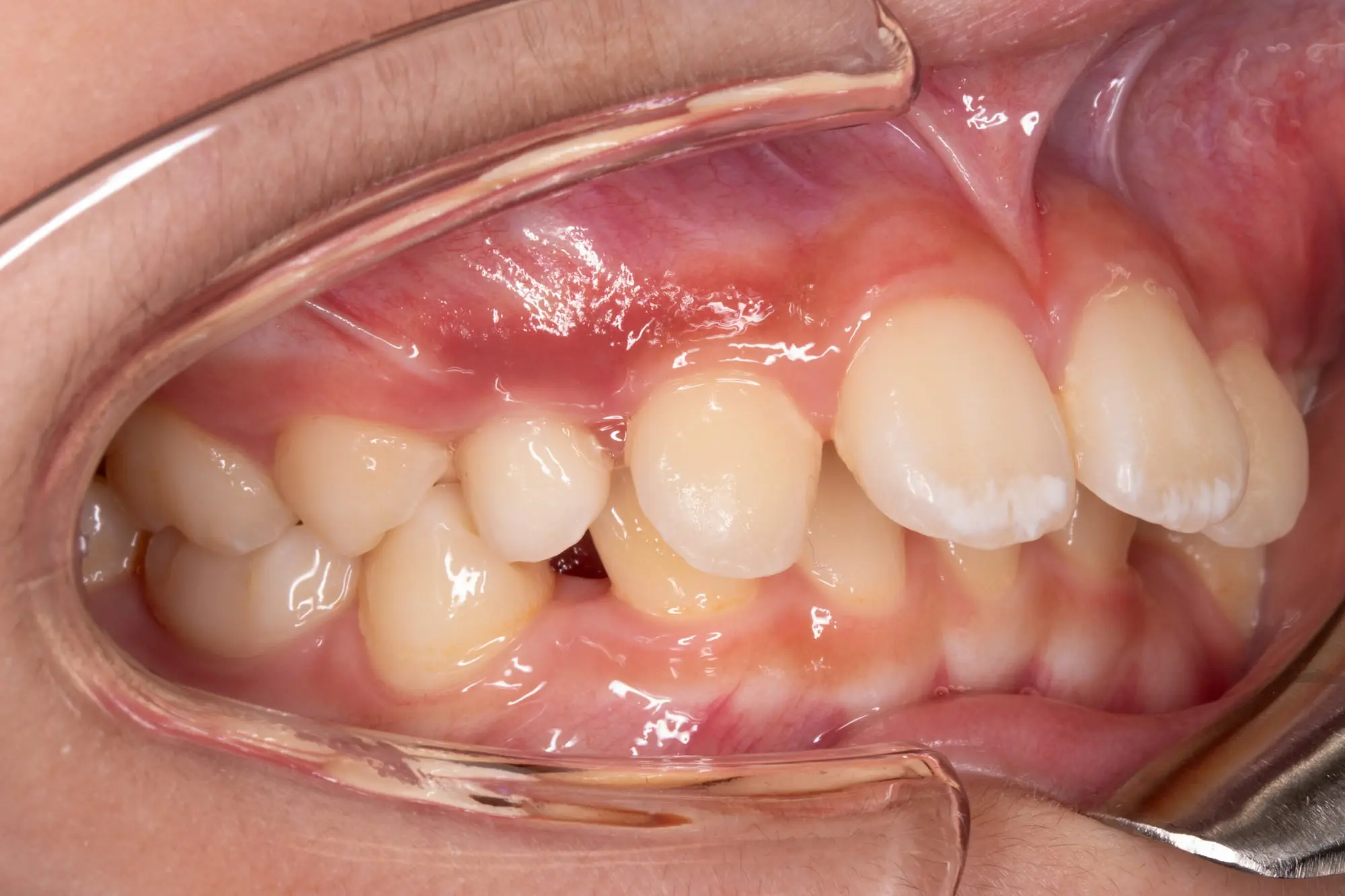 Before treatment at Emerald City Orthodontics in Kirkland, WA, close-up of misaligned and crowded lower front teeth with retractors.