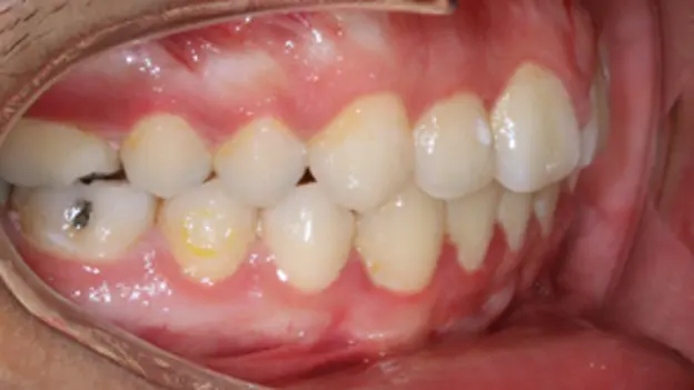 After successful open bite closure and alignment at Emerald City Orthodontics in Kirkland, WA.