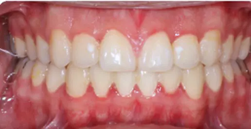 After successful open bite closure and alignment at Emerald City Orthodontics in Kirkland, WA.