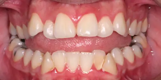 Before open bite orthodontic treatment at Emerald City Orthodontics, Kirkland, WA.